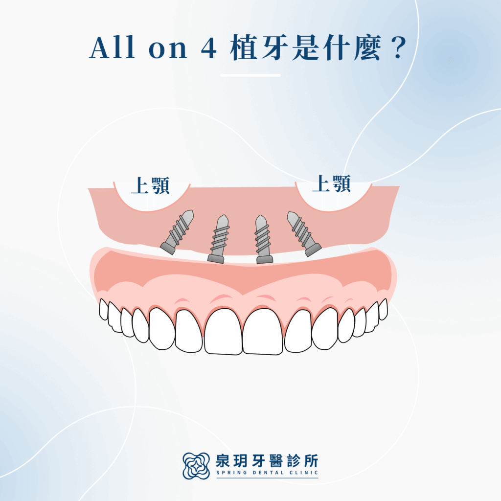 All-on-4 是什麼
