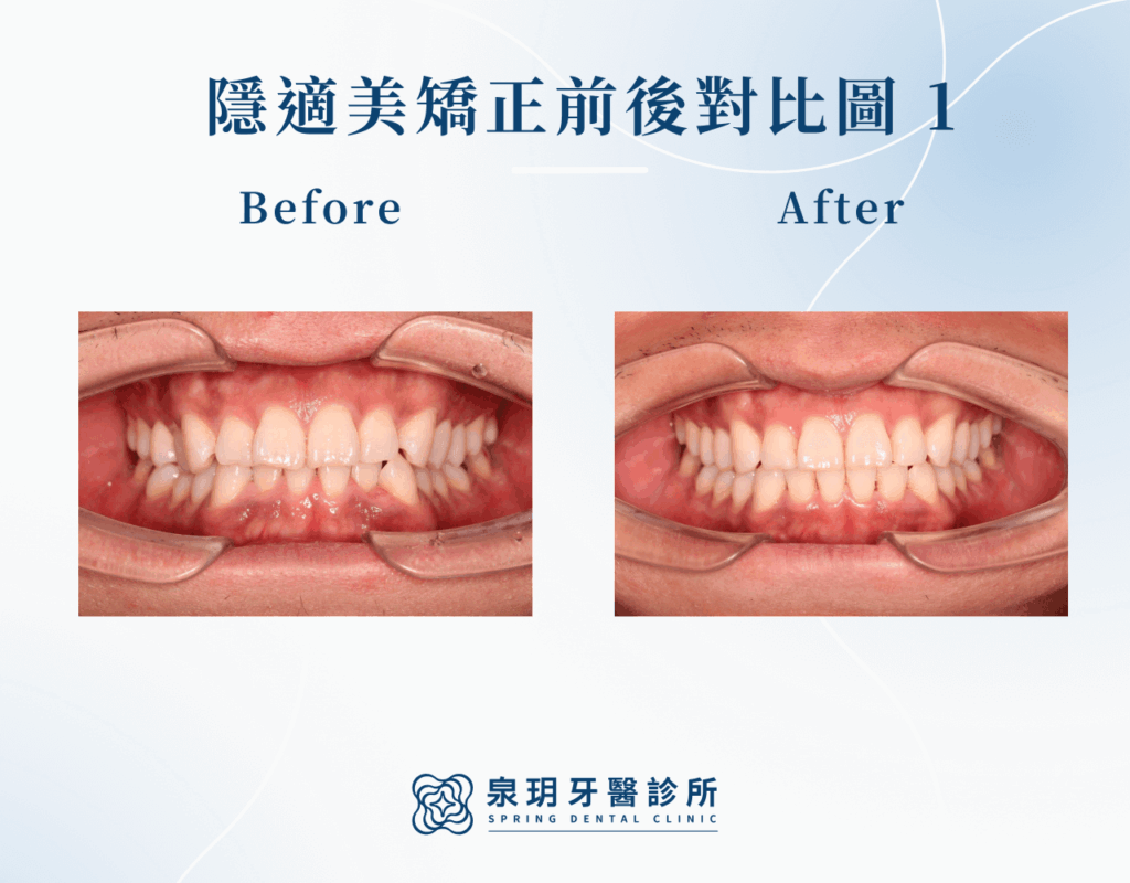 隱適美矯正成功案例1
