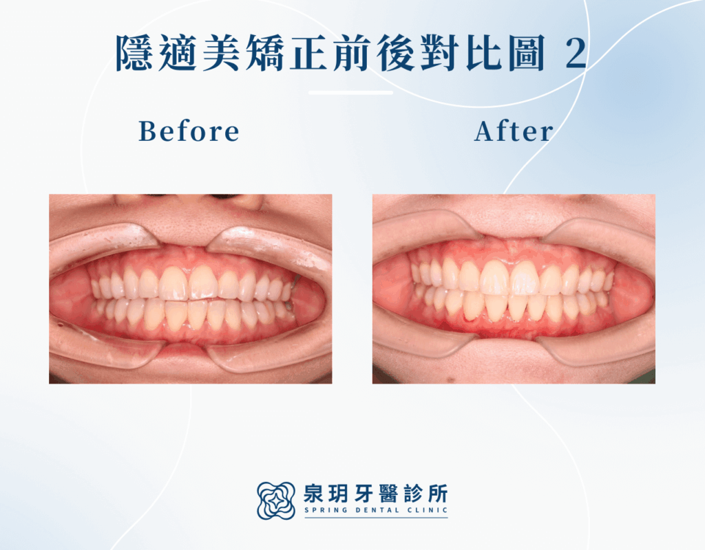 隱適美矯正成功案例2