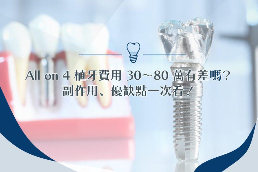 All on 4 植牙費用 30 ~ 80 萬有差嗎？副作用、優缺點一次看！