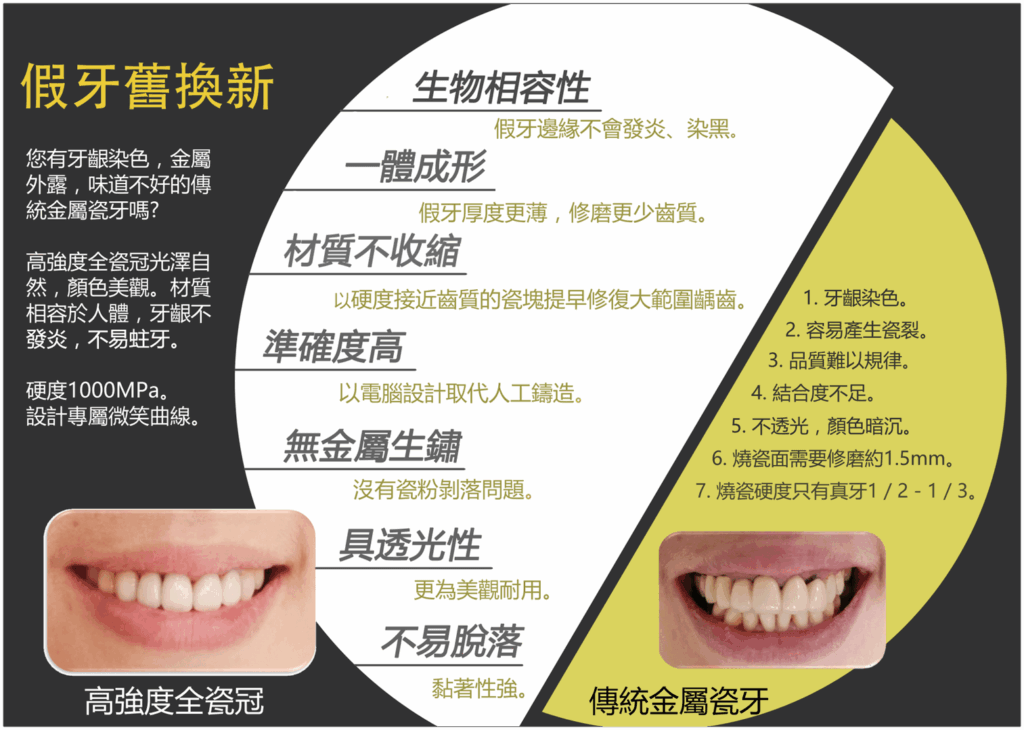 全瓷冠適合更換舊假牙