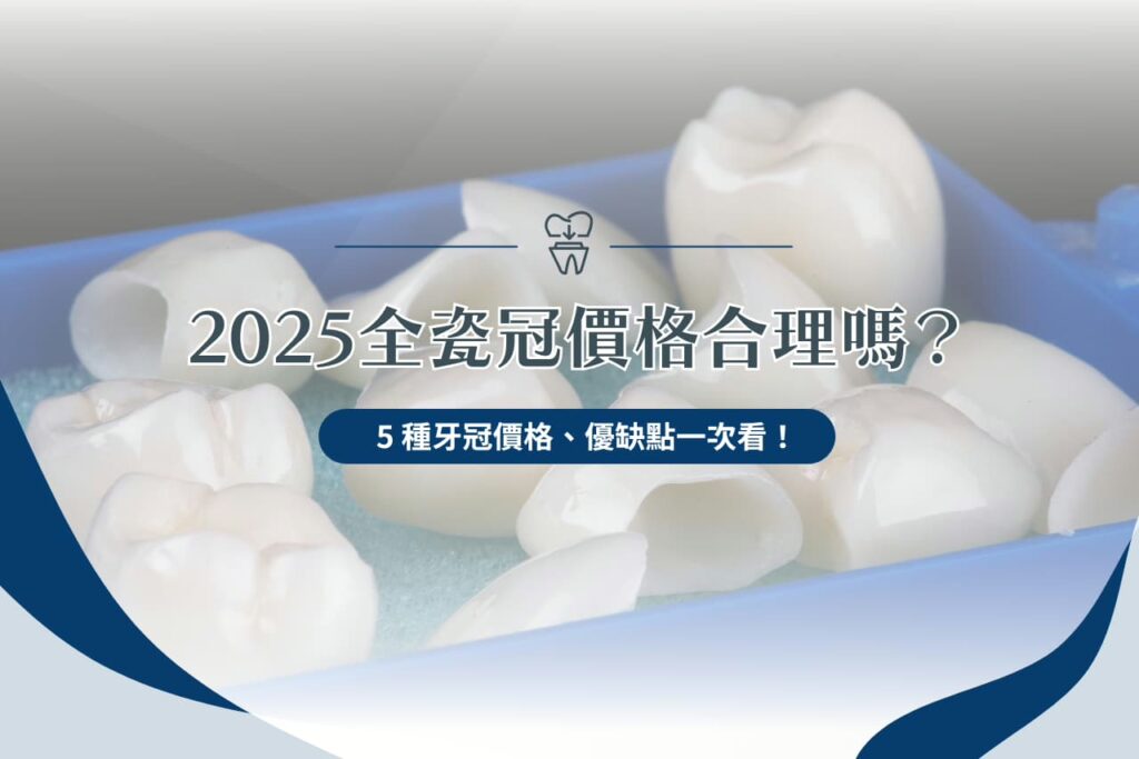 2025 全瓷冠價格合理嗎？ 5 種牙冠價格、優缺點一次看！