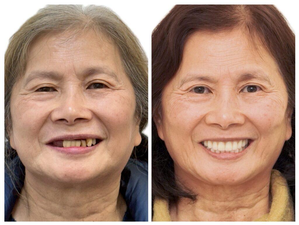 全口重建改善臉型1