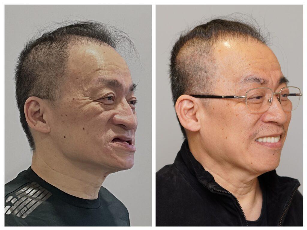 全口重建改善臉型2