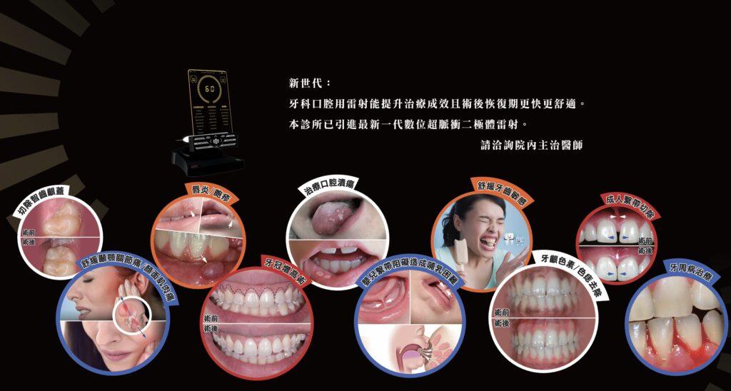 牙周雷射可治療多種慢性疼痛