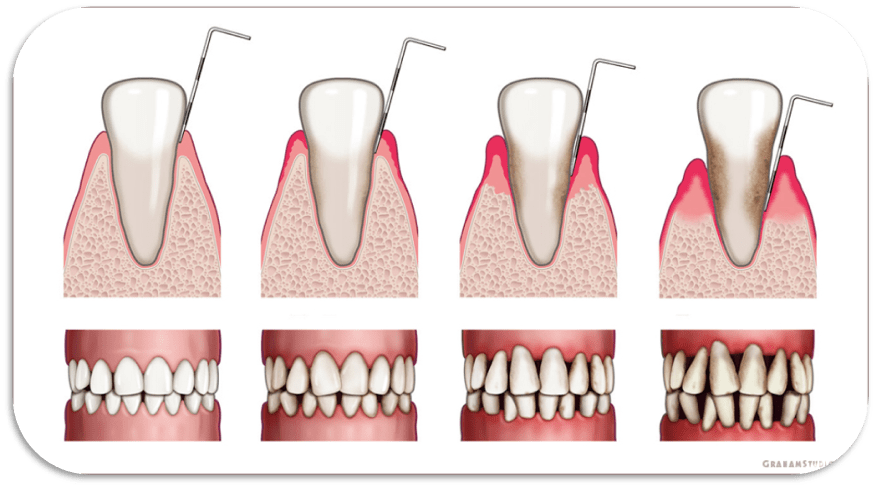 牙周病過程