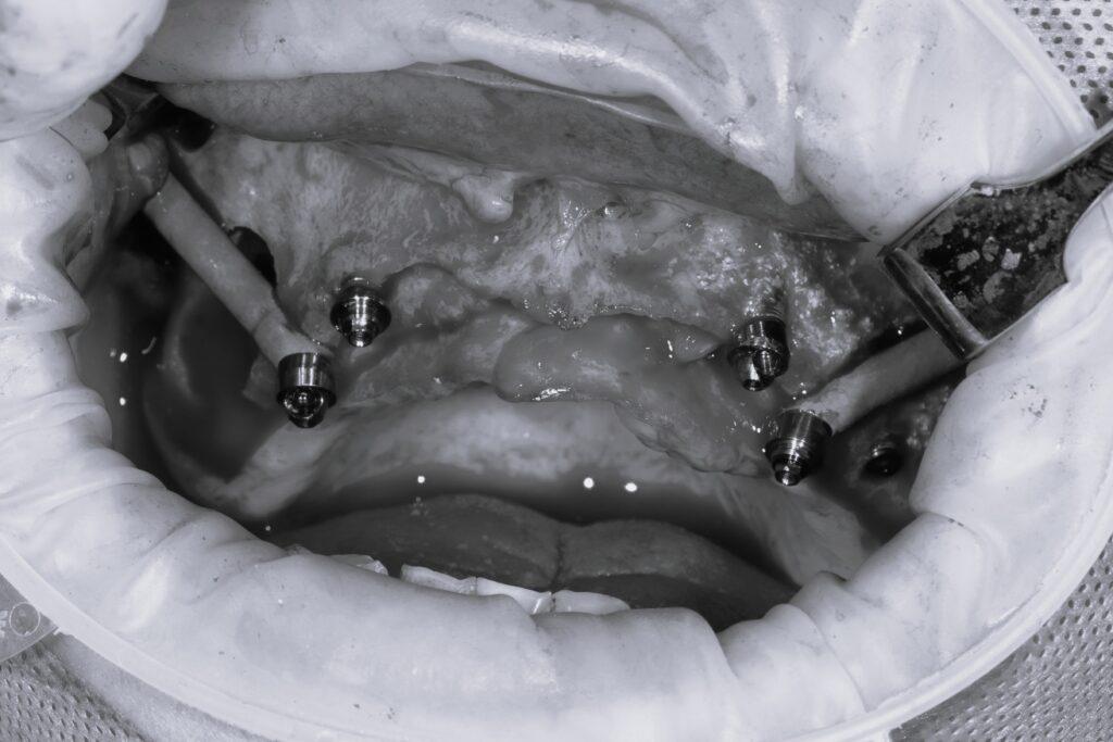 顴骨植牙傷口範圍。