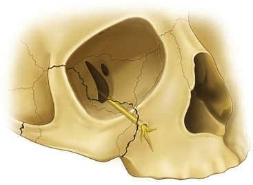 顴骨植牙風險,下眼眶。