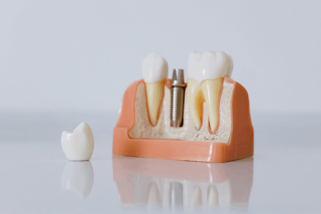台北牙醫推薦、缺牙、全口 植牙 費用、牙齒、假牙、缺 牙、植牙費用、植牙過程