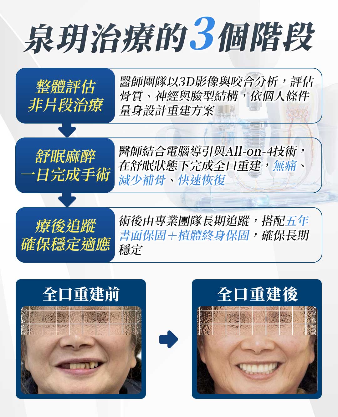 台北牙醫推薦、缺牙、全口 植牙 費用、牙齒、假牙、缺 牙、all on 4 全口重建 費用