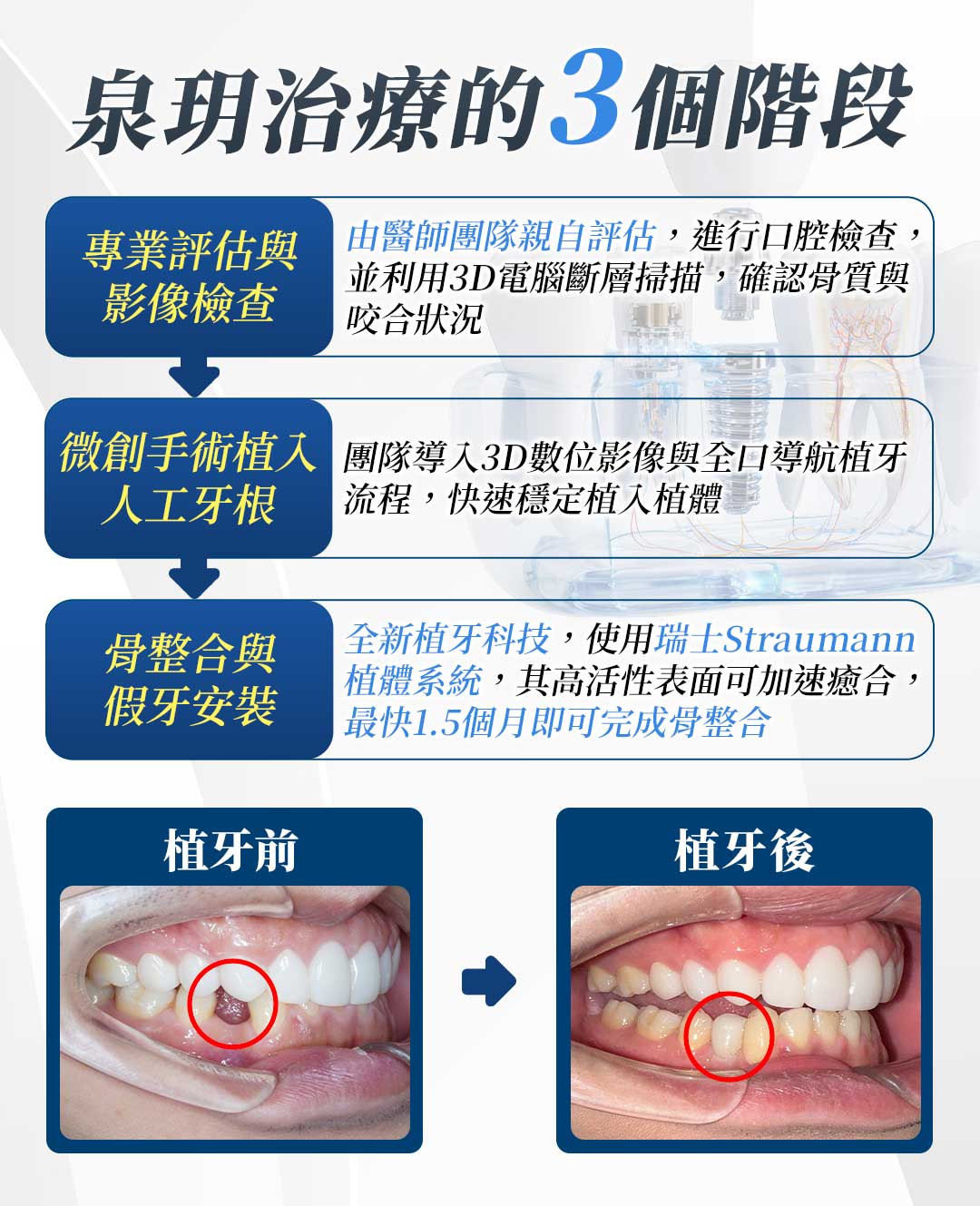 台北牙醫推薦、缺牙、全口 植牙 費用、牙齒、假牙、缺 牙、植牙費用、植牙過程