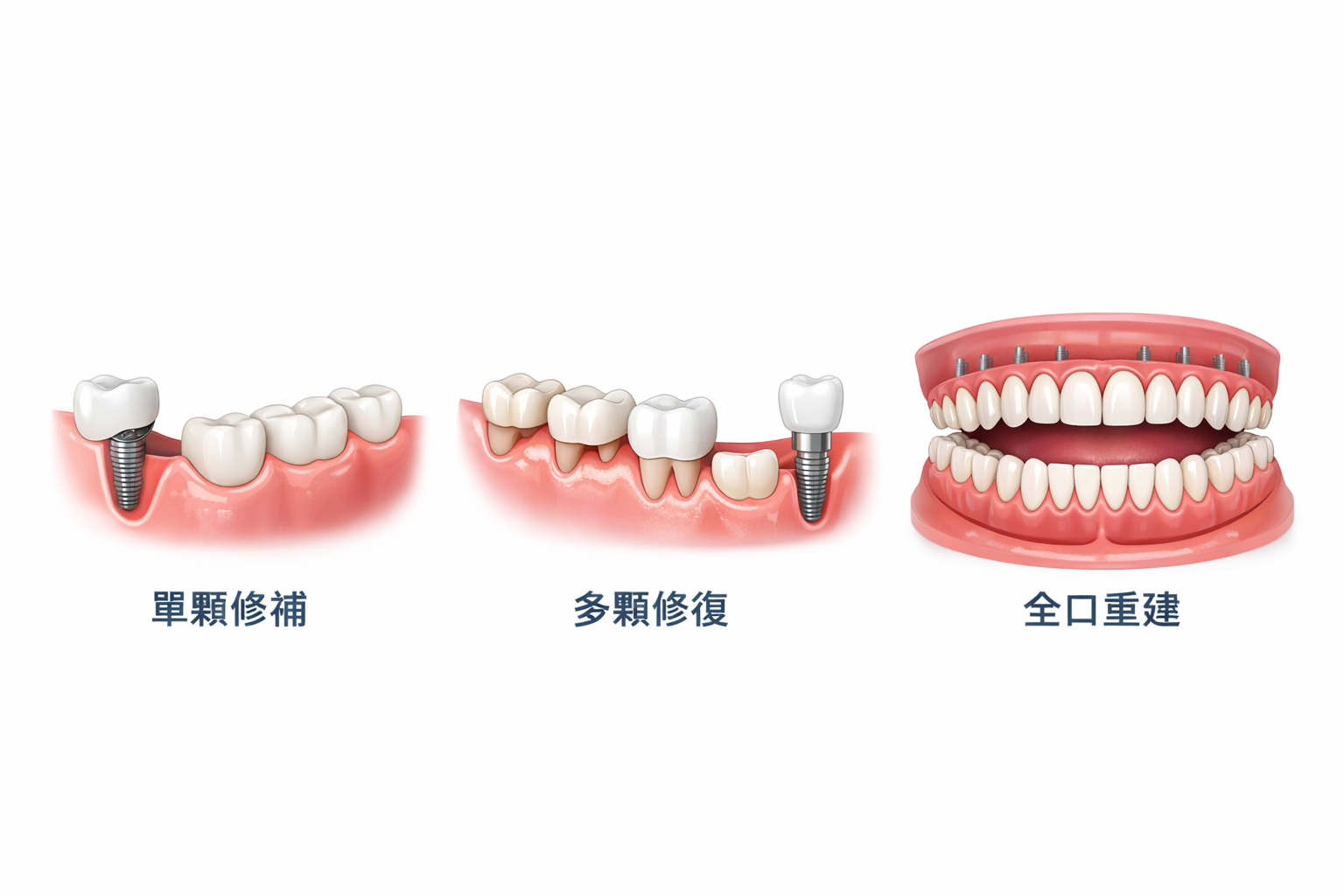 全口重建、單顆修復、多顆修復差異在哪？＿泉玥牙醫